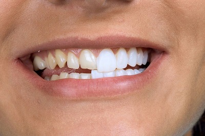 фото зубных виниров